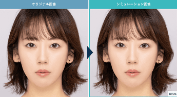 TCB東京中央美容外科の二重AIシミュレーションの画像